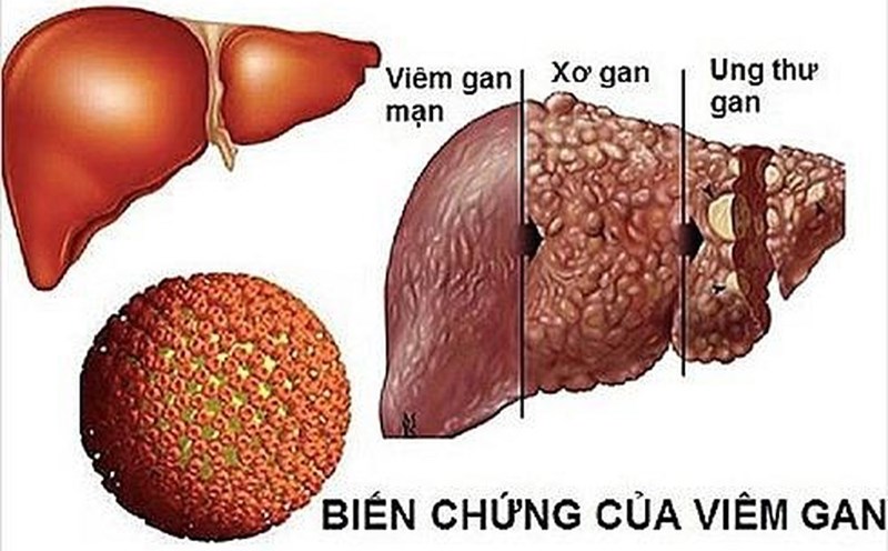 Triệu Chứng Bệnh Gan - Nhận Biết Sớm Để Bảo Vệ Sức Khỏe